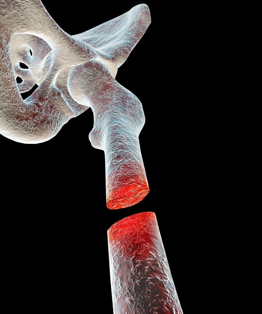 Preserving Bone Health, A Guide to Preventing and Managing Bone Defects ...